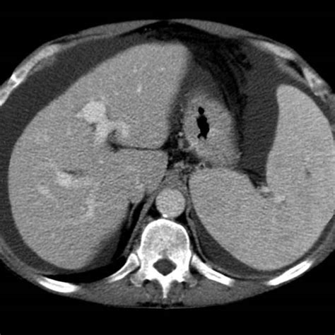 Focal Nodular Hyperplasia Radiology