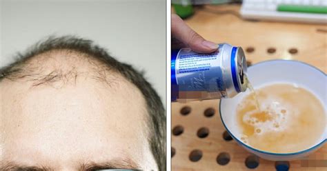 Washing Your Hair With Beer Can Reduce Dandruff And Hair Loss