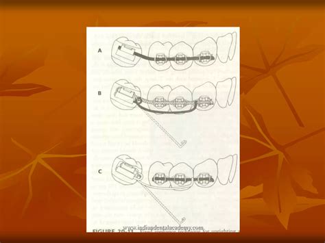 Molar Uprighting Ppt