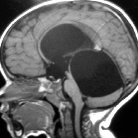 Pdf Neuroendoscopic Treatment Of Quadrigeminal Arachnoid Cyst In A
