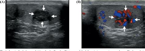 Figure 1 From The Prevalence Of Testicular Adrenal Rest Tumors And