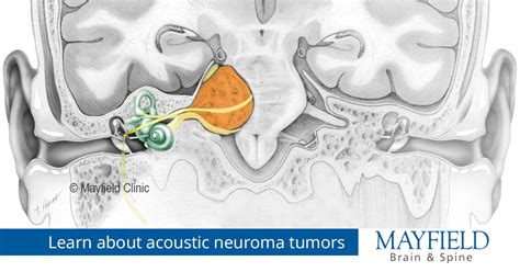 Acoustic Neuroma Vestibular Schwannoma Cincinnati Oh Mayfield Brain