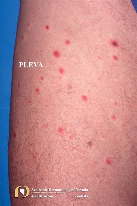 Pleva Pityriasis Lichenoides Et Varioliformis Acuta Academic