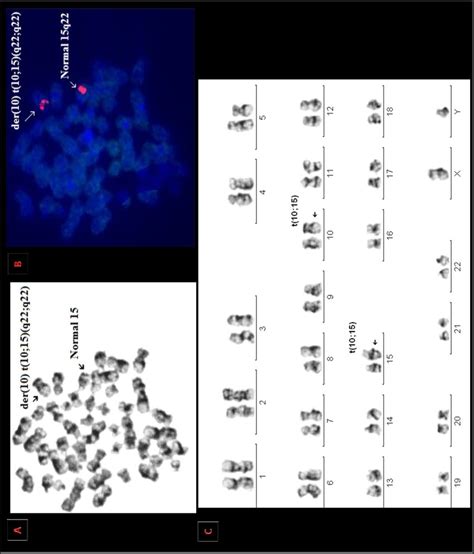 A Image Of A Gtg Banded Bone Marrow Metaphase Before Fish Analysis