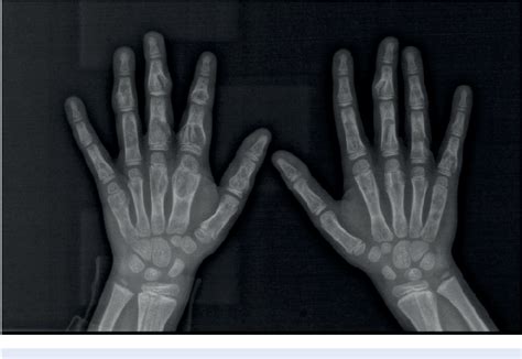 Figure 2 From Extended Oligoarticular Juvenile Idiopathic Arthritis