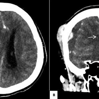 A Contrast Enhanced Computerized Tomography Cect Brain Showing A