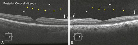 Stages Of Posterior Vitreous Detachment Clinical Tree
