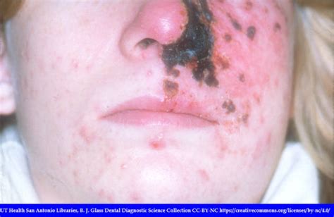 Shingles On Face