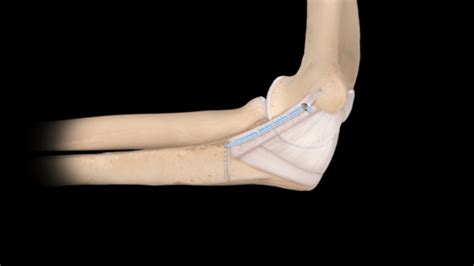 Ulnar Collateral Ligament Ucl Injuries Treatment Options