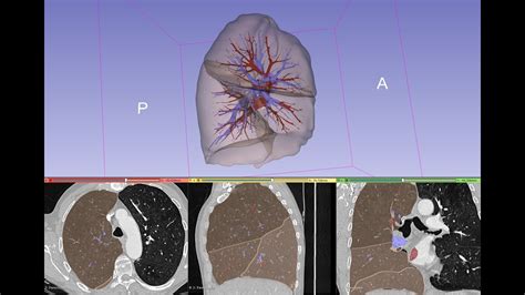 Automated Lung Vasculature Segmentation With Deep Learning 43 OFF