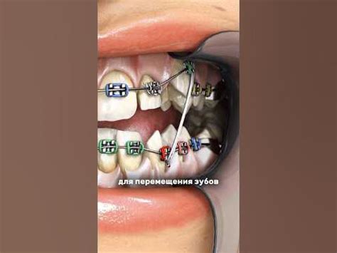 Межчелюстные тяги #брекетыалматы #стоматологалматы #ортодонталматы ...