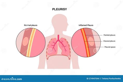 Pleurisy Inflammation Diseases Stock Vector - Illustration of inhale, thoracic: 274947044