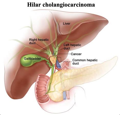 Hilar Cholangiocarcinoma Symptoms Diagnosis And Treatment