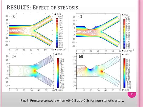 Computational Simulation Of Blood Flow In Stenosed Arterial Bifurcation