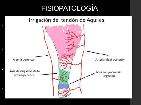 RUPTURA DEL TENDON DE AQUILES Pptx