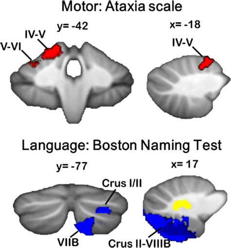 The Cerebellar Cognitive Affective Schmahmann Syndrome A Task Force