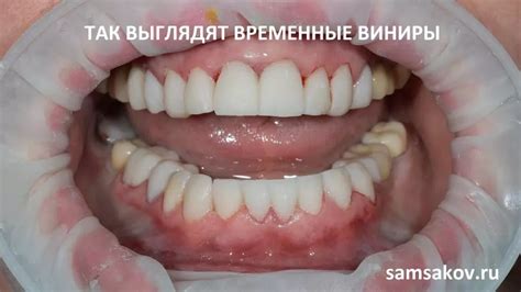Установка виниров на зубы. Фото, видео до и после, цена | Альянс бьюти ...