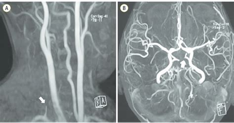 Magnetic Resonance Angiography Mra Performed At The Previous Hospital