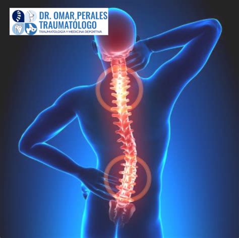 Dolor De Espalda Dr Perales Traumatólogo