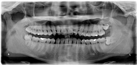 Wisdom teeth - wikidoc