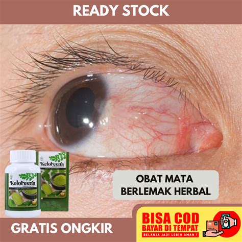 Obat Mata Berlemak Obat Penyakit Pterigium Obat Mata Pterygium Obat