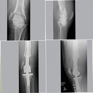 Left knee. Antibiotic-loaded cement spacer following left total knee ...