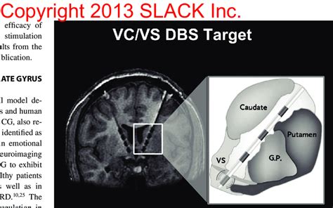 The Location Of The Ventral Capsule Ventral Striatum Vc Vs Deep Brain Download Scientific