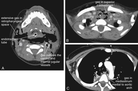 Imaging Soft Tissues Of The Neck Radiology Key