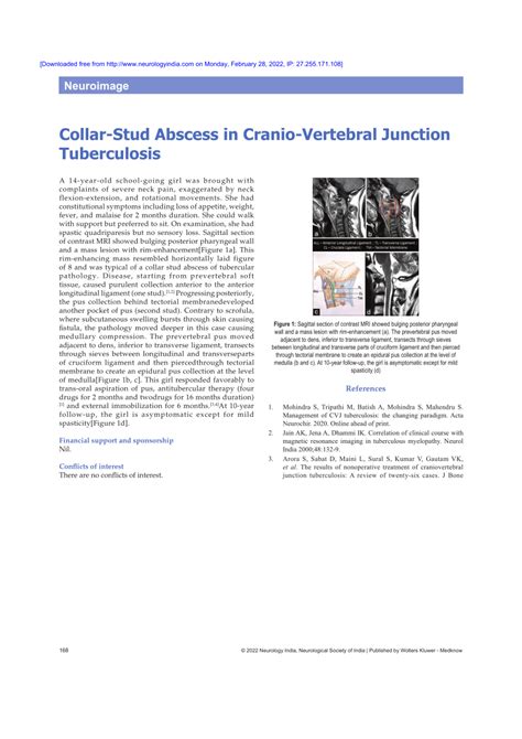 collar stud abscess  cranio vertebral junction tuberculosis