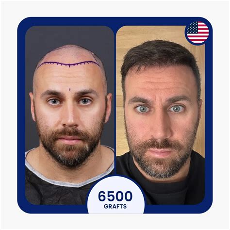 hair transplant  korea  turkey vera clinic
