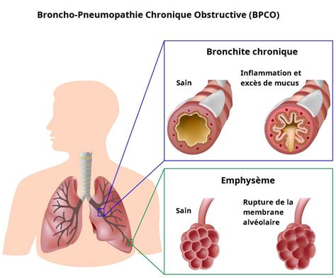 BPCO symptômes stades quelle espérance de vie