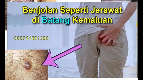 Benjolan Di Tepi Kemaluan Tumbuh Benjolan Seperti Jerawat Di Sekitar