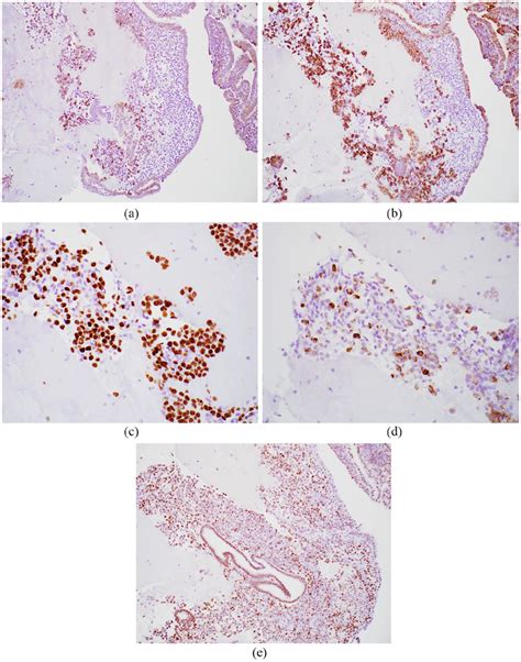 Endometrial Biopsy Ihc Cells Staining Positive For A Ck Ae Ae