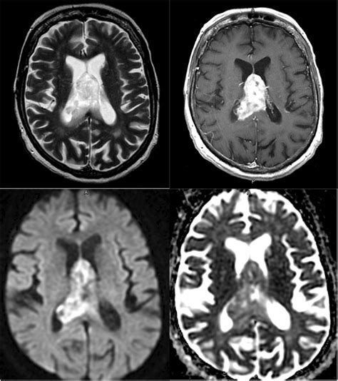 Mri Of Intracranial Intraventricular Lesions Clinical Imaging