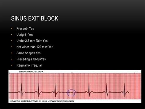 P wave axis and escape rhythms