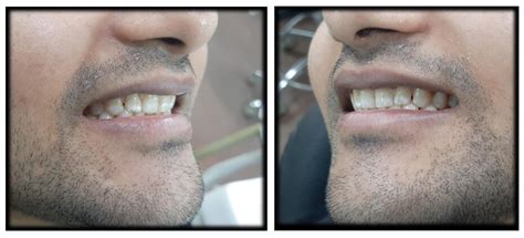Smile Designing Mild Fluorosis Mohit Richardsons Plastic Surgery