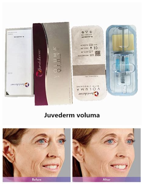 Ultra3 2 1ml Syringe Juvederm Hyaluronic Acid