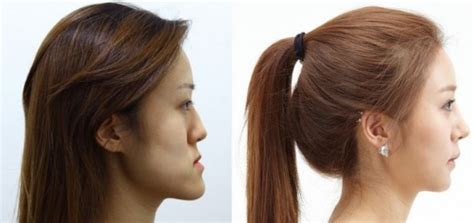 Plastic Surgery Archives Boring Duckling