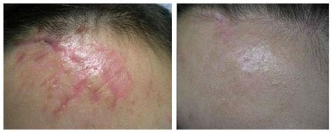 Удаление шрамов и растяжек лазером. Лазерное удаление рубцов в Иркутске