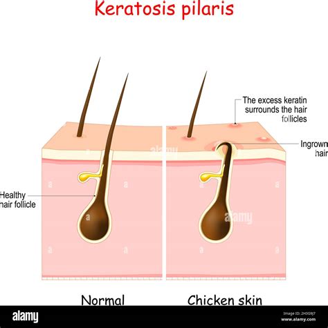 Hyperkeratosis Hair Follicle Cut Out Stock Images And Pictures Alamy