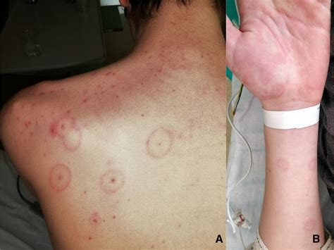 Special Dermatological Presentation Of Paediatric Multisystem Inflammatory Syndrome Related To