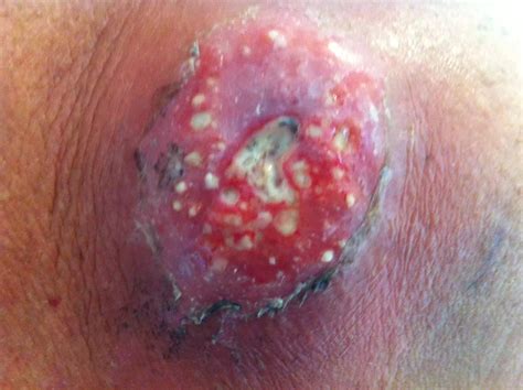 Staph Infection Stages: Pictures and Symptoms