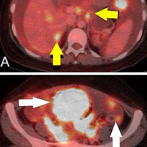 A Post Surgery Contrast Enhanced Ct Scan Axial Image Showed Bulky Download Scientific Diagram