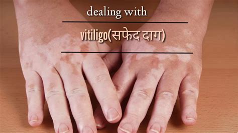 Medicalhelp सफेद दाग Leucoderma Vitiligo Treatment Cause And Diagnosis Hindi English Youtube