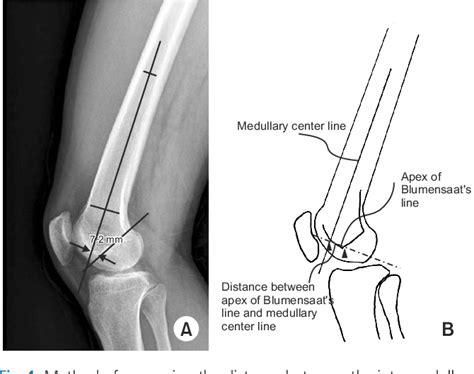 Figure 1 From Factors Affecting Posterior Angulation In Retrograde