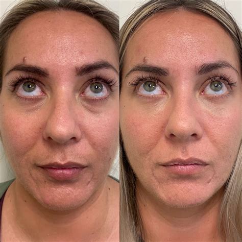 Non Surgical Face Lift Au