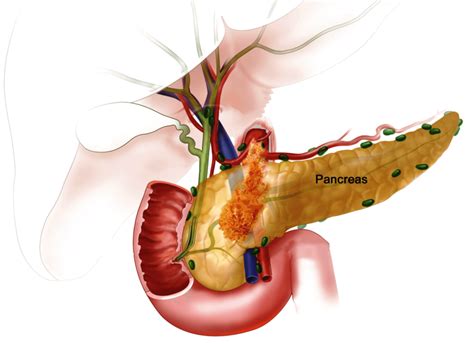 U đầu tụy có nguy hiểm không và phương pháp điều trị