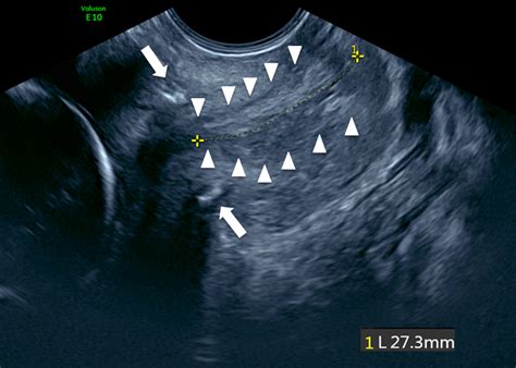 Three‐dimensional Ultrasound Imaging Of Intra‐abdominal Cervical