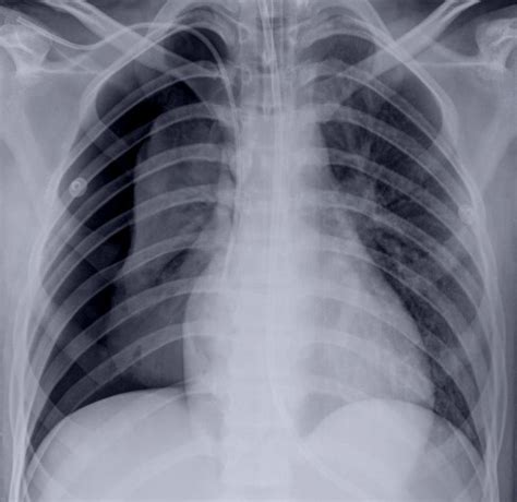 Pneumotórax O Que É - Pneumotórax espontâneo: o que é isso? - Medway