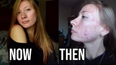 How I Cleared My Skin Naturally My Acne Journey Youtube